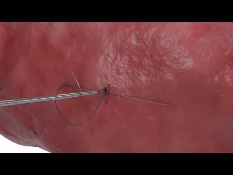 StitchLock in Action