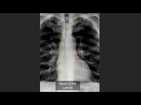 Swan Ganz Catheter Positioning on CXR