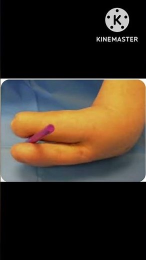 Krukenberg procedure/Below elbow amputation.