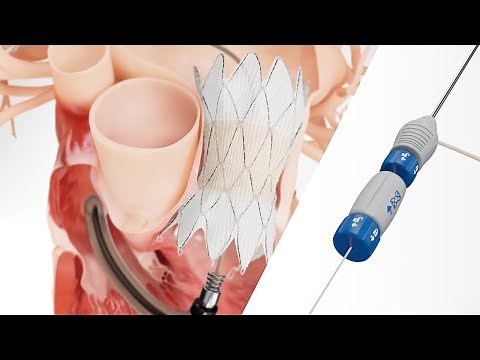 Harmony™ Transcatheter System Implantation