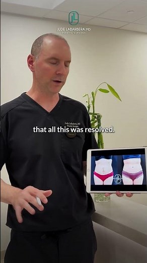 Tummy Tuck and Scar Revision Patient Story