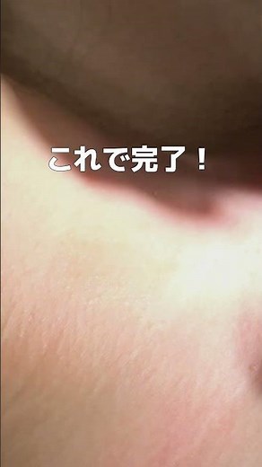 イボ除去の様子！ 電気メスでいぼを取ります。
