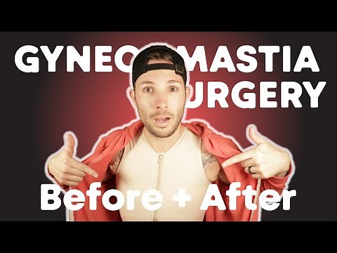 My Gynecomastia Surgery | Before & After Gyno Surgery + Advice For Those Getting Gynecomastia Sugery