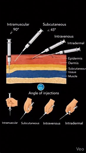 𝐄𝐗𝐏𝐋𝐎𝐑𝐄 𝐍𝐔𝐑𝐒𝐈𝐍𝐆 🎯✨ on Instagram: "Proper knowledge of injection techniques is critical for safe and effective medical practice. This illustration explains the four main types of injections—Intramuscular, Subcutaneous, Intravenous, and Intradermal—along with their correct angles and depth of administration. Each method targets a specific tissue layer, which directly affects drug absorption, effectiveness, and patient safety. This content is shared strictly for educational and aware