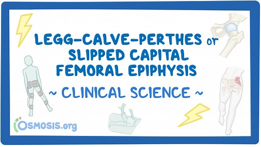 Legg-Calve-Perthes disease and slipped capital femoral epiphysis: Video & Meaning | Osmosis
