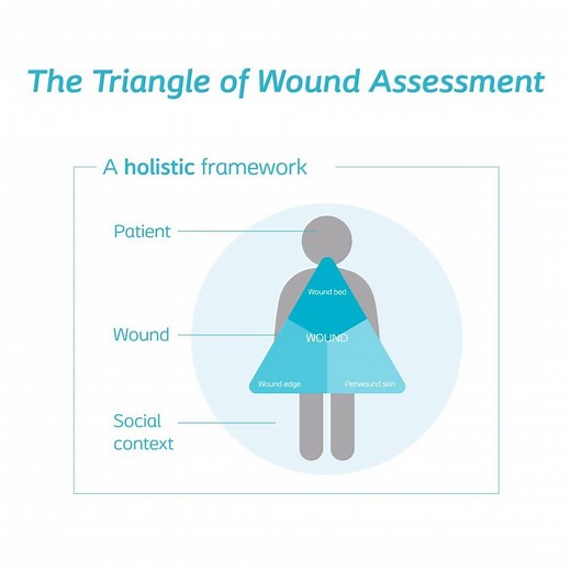 The Triangle of Wound Assessment is a holistic framework that allows practitioners to assess and manage all areas of the wound: wound bed, wound edge and the periwound skin. It is a simple and systematic approach that guides the user from complete wound assessment to setting management goals and selecting the relevant treatment options. Watch this animation to learn more. | Coloplast Wound and Skin Care