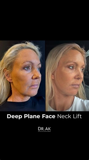 Dr.Erman Ak | Deep Plane Face & Neck Lift in Turkey Over time, the face and neck can lose their natural definition — but with a deep plane face and neck... | Instagram