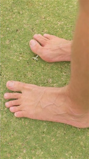 Bunions Explained (See Description) 👣