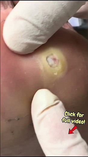 Part 7 - Deep Corn Extraction (The Final Pul!) #satisfying #satisfyingshorts #shortsfeed