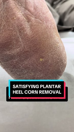 This Painful corn in the centre of this heel needed removing! #fyp #foryou #foryoupage #viral #sydney #podiatry #australia #corn #feet #foot #satisfying #cornremoval #pimple #tiktok #podiatrist #toes #heels