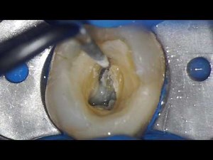 Endodontic Access