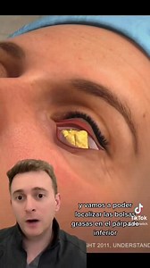 How is lower blepharoplasty done?