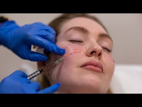 PRP | PRP under eye treatment | Cosmetic nurse injector