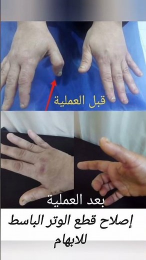 Extensor tendon rupture of the thumb .Reconstruction by tendon transfer.