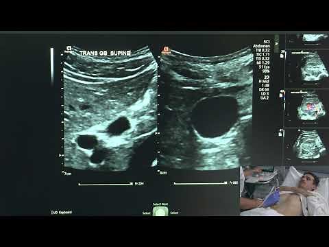 Ultrasound of the Gallbladder