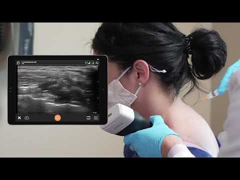Supraclavicular Brachial Plexus Nerve Block - Ultrasound Scanning Technique