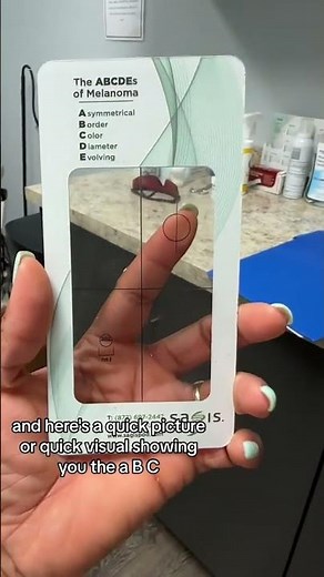 Check Your Skin: The ABCDE Guide to Melanoma