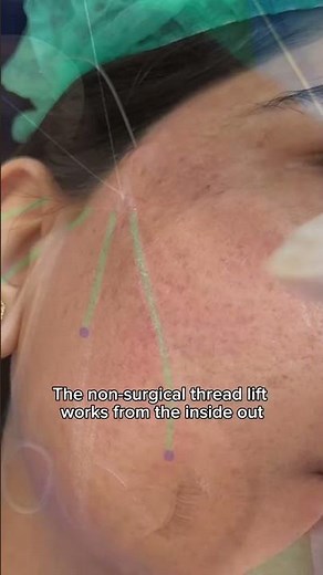 Thread lift: The 15 min facelift.