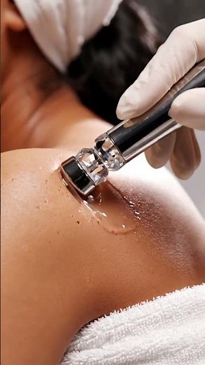 Most Satisfying Blackhead Vacuum Extraction Ever! Real Deep Pore Cleaning ASMR for Stress Relief,