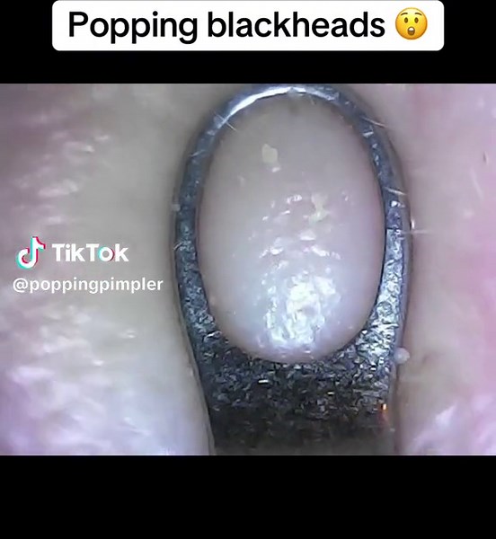 Effective Blackhead Removal Techniques