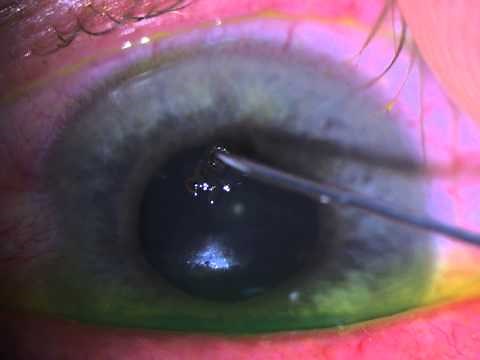 Corneal Foreign Body Removal
