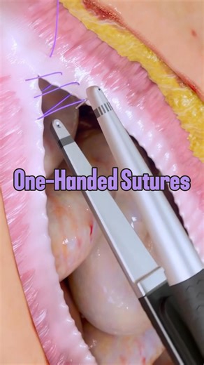 Vetventures on Instagram: "New One-Handed Suturing Tool! ✋ Use Code Vetventures for 10% off @thesuturebuddy suture kits! #doctorsofinstagram #veterinariansofinstagram #surgeonsofinstagram #surgery #suturekit #woundcare #medicine #nursesofinstagram #vetsofinstsgram #hacks #medicalinstagram #vet #innovaion #stitches #lefthanded #righthanded #onehanded"