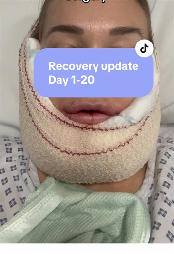 Double Jaw Surgery Recovery: What to Expect