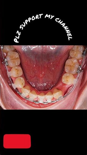 “Amazing Teeth Correction Transformation | Before & After Orthodontic Fix”