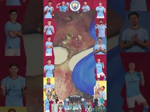 Blackheads Removal | Acne Treatment and Very Satisfying Satisfying Pimple pop #blackheads