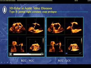 The aortic valve
