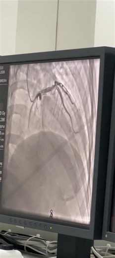Actual video of angiogram