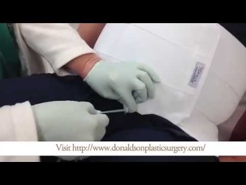 How To Strip a Post-Surgical Drain After Abdominoplasty