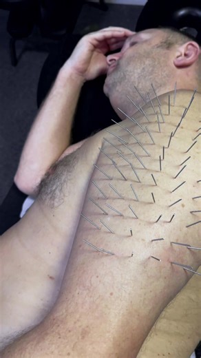 Benefits of Multi Dry Needling ✨ ✔️ Reduces muscle tension – releases tight, overactive muscles ✔️ Improves mobility & flexibility – helps you move more freely ✔️ Speeds up recovery – great for athletes and active lifestyles ✔️ Decreases nerve pain – interrupts pain signals and improves circulation ✔️ Boosts muscle activation – supports better movement patterns ✔️ Treats the root cause – not just the symptoms Perfect for chronic pain, sports injuries, postural tension, or stubborn tight areas. �