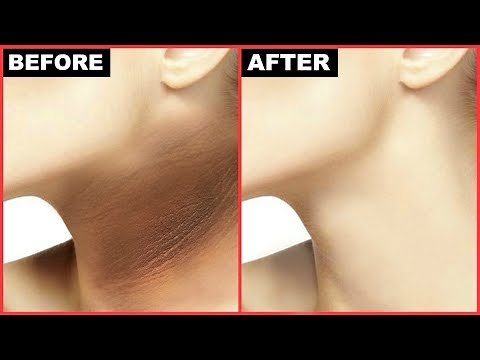 How To Get Rid Of Dark Neck In 15 Minutes - Black Neck, HyperPigmentation | Anaysa