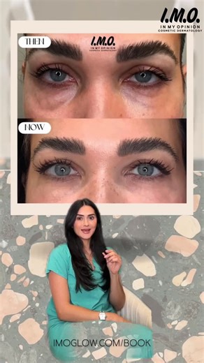 Leslie Rohaidy PA AAOPM Fellow on Instagram: "MORPHEUS8 ADVANCED - FOR THE EYES⁣ 👁️⁣ + NEED TO KNOW: minimal downtime, comfortable, fast. This result is 14 days after ONE session. Patient was comfortable throughout the procedure, experienced little to no bruising, swelling, itching, or flaking. She was able to resume daily life activities next day. + Morpheus8 is an aesthetic SURGERY device according to FDA filings made available to the public. This is not a simple micro needling pen. + This SO