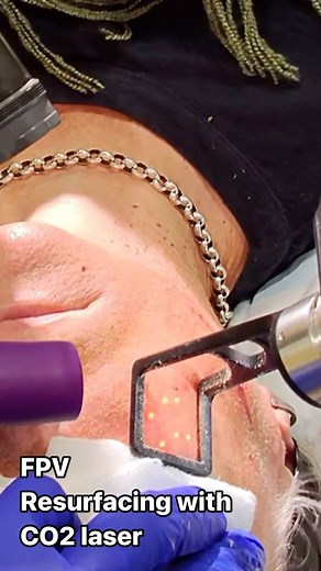 Dr Davin Lim & VP on Instagram: "FPV with Meta, CO2 resurfacing with the newest Deka Tetra Pro laser 🔫⚡️ . 😎Dr Davin Lim Dermo 🇦🇺 . #co2laser #laserresurfacing #dekalaser #co2fractionallaser #fractionallaser @dekalaser_official"