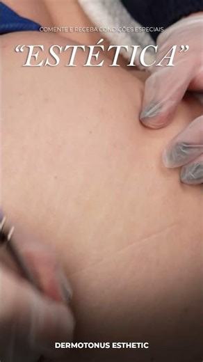 PEELING DE DIAMANTE PARA TRATAR ESTRIAS