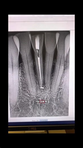 10K views · 66 reactions | #dentistry #dentalschool #dentists #rootcanaltherapy #hygienist | Advanced Micro-Endodontics | Facebook