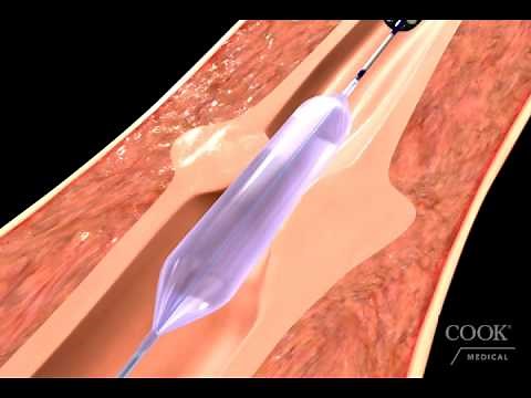 Hercules® 3 Stage Balloon Dilator Animation