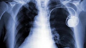 Artificial pacemaker: Here's When It Becomes A Must For Heart Patients