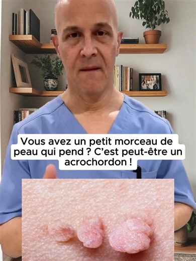 Tout savoir sur les acrochordons : causes et traitements