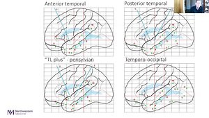 Invasive EEG Monitoring: Stereo EEG & Defining the Epileptic Zone