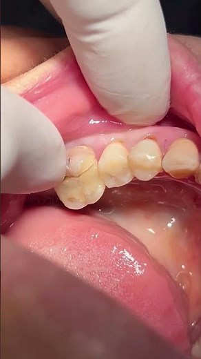 Fracture of root canal treated tooth #dentist