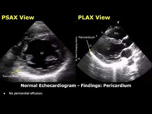 Echocardiography Reporting | Heart Ultrasound | How To Write USG Reports | Cardiac Diseases