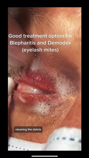 BlephEx, blepharitis (eyelid inflammation) and demodox (eyelash mites) treatment.
