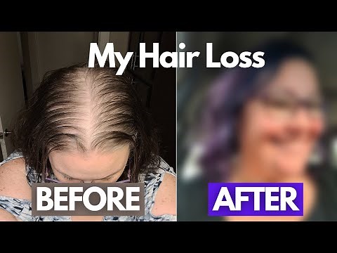I Cut Off My Hair - My Mounjaro Hair Loss Journey | Tirzepatide Week 18