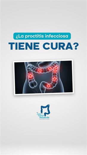 🚨 Proctitis Infecciosa: ¡Sí tiene cura! ✅ No dejes que se cronifique. Aquí te explico lo esencial : 🔍 No todo es lo mismo: Para curar la proctitis infecciosa, es vital identificar el agente causal (virus , bacterias u hongos ). 🎯 Diagnóstico y Tratamiento Específico: Sin el germen correcto identificado, el problema se cronifica. Con un diagnóstico específico, aplicamos el tratamiento adecuado (antibióticos, antivirales u otros medicamentos 💊). ¿Tienes síntomas? Si presentas dolor, sangrado �