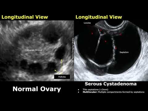 Gynecological Ultrasound Ovary Normal Vs Serous Cystadenoma | Benign Ovarian Cystic Neoplasms USG