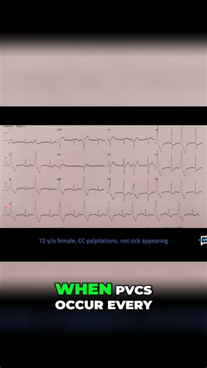 Practical EMS on Instagram: "PVCs every other beat? That's bigeminy. Palpitations or shortness of breath can happen. Understanding heart rhythms is key. #Bigeminy #PVCs #HeartRhythm #Palpitations #Cardiology #EKG #MedicalEducation #ReelsOfInstagram"