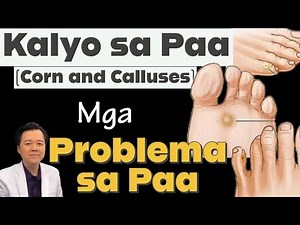 Kalyo sa Paa (Corn and Calluses). Mga Problema sa Paa. - By Doc Willie Ong